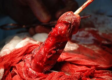 Operacja wydłużenia penisa